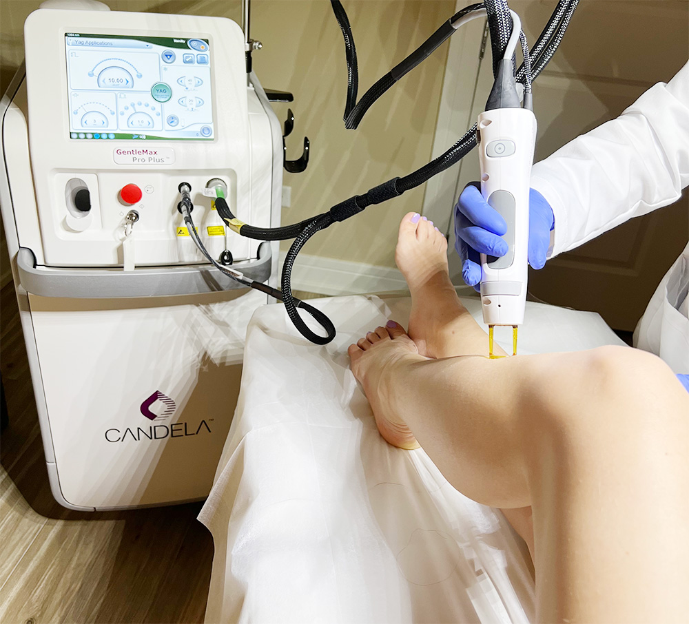 laser hair removal